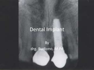 Dental Implant
By
drg. Budiono, M.Pd
 