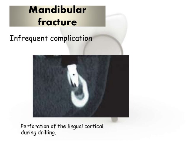 Complications of mandibular fracture
