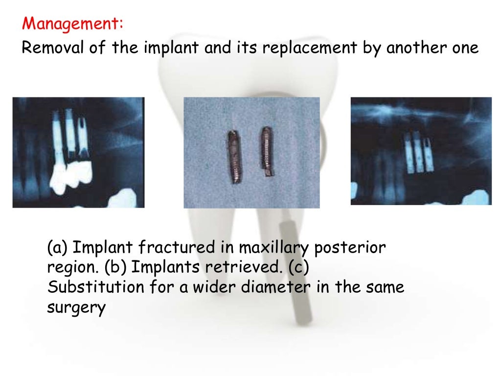 Dental implant complications