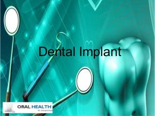 Dental Implant
 