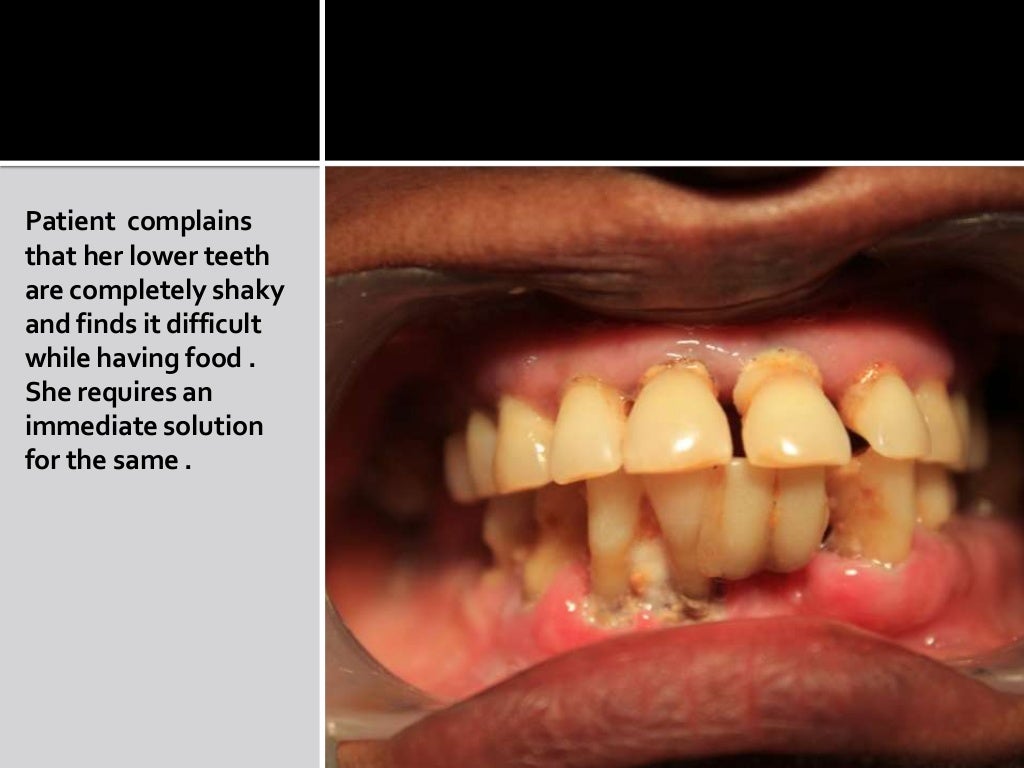 Dental implant for diabetic patients ppt
