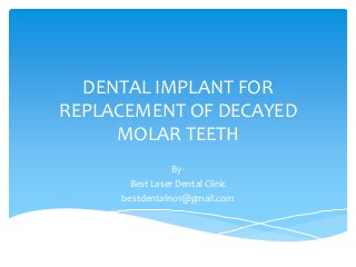 DENTAL IMPLANT FOR
REPLACEMENT OF DECAYED
MOLAR TEETH
ByBest Laser Dental Clinic
bestdentalno1@gmail.com

 