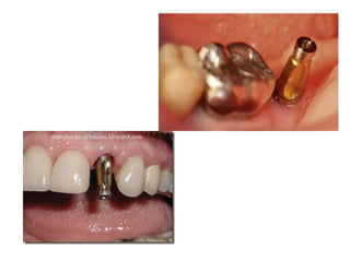 Dental implant impression techniques