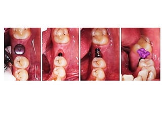 Dental implant impression techniques