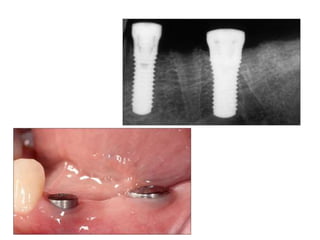 Dental implant impression techniques