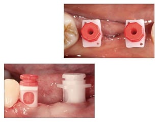Dental implant impression techniques