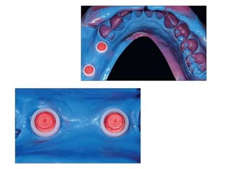 Dental implant impression techniques