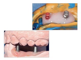 Dental implant impression techniques