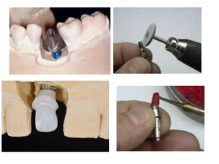 Dental implant impression techniques