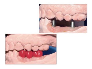 Dental implant impression techniques