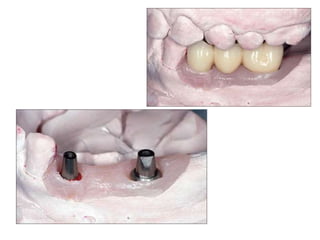 Dental implant impression techniques