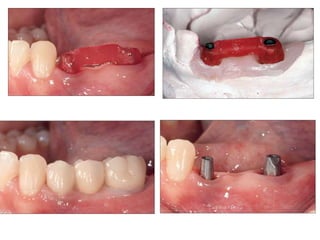 Dental implant impression techniques
