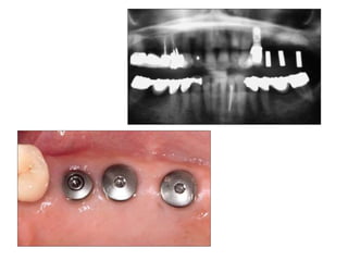 Dental implant impression techniques