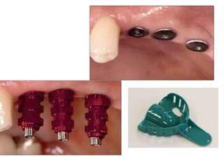 Dental implant impression techniques