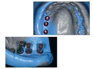 Dental implant impression techniques