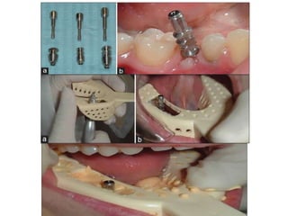 Dental implant impression techniques