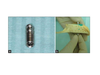 Dental implant impression techniques