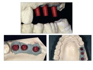 Dental implant impression techniques