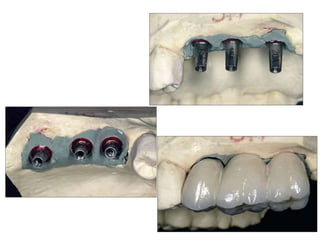 Dental implant impression techniques