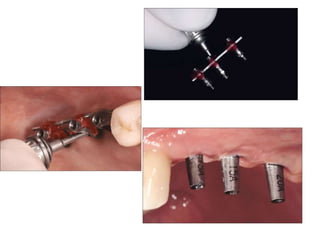 Dental implant impression techniques