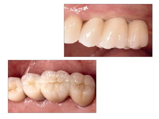 Dental implant impression techniques