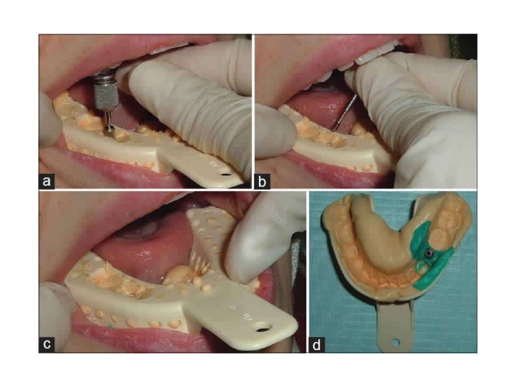 Dental implant impression techniques