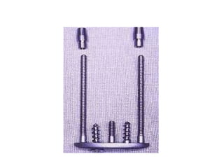 • Tapered screw implants can be :
Two piece implant
Single piece implant
 