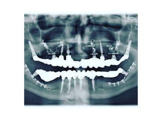 • Implants with more threads (i.e. smaller pitch)
were found to have a higher percentage of BIC
and increase resistance to...
