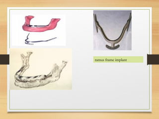 ramus frame implant
 