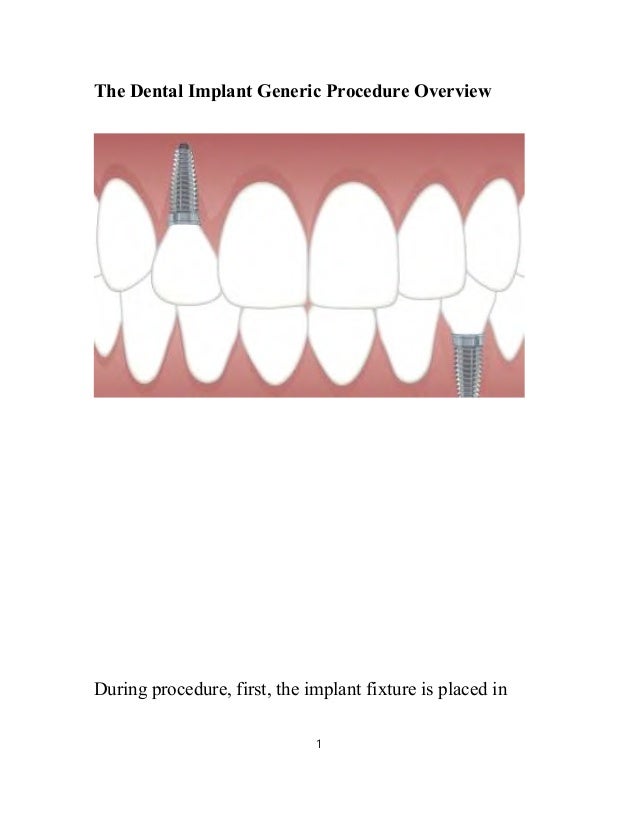 Dental Implant PPT Slideshare