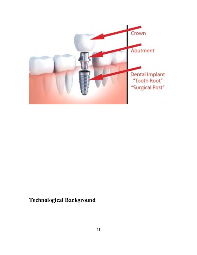 Dental Implant PPT Slideshare
