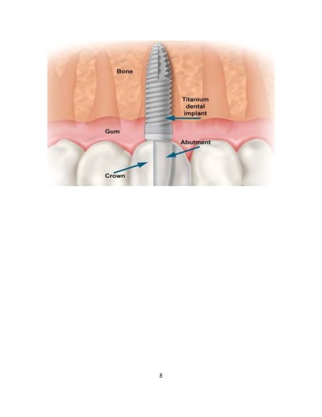 Dental Implant PPT Slideshare