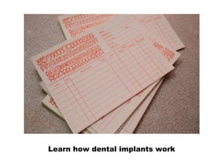 Learn how dental implants work
 