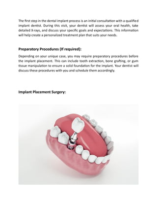 Step By Step Dental Filling Procedure - Dr. Elston Wong Dentistry