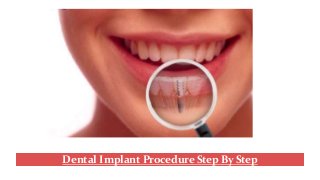 Dental Implant Procedure Step By Step
 