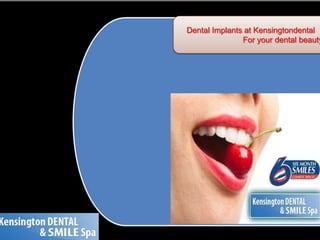 Dental Implants at Kensingtondental 	For your dental beauty 