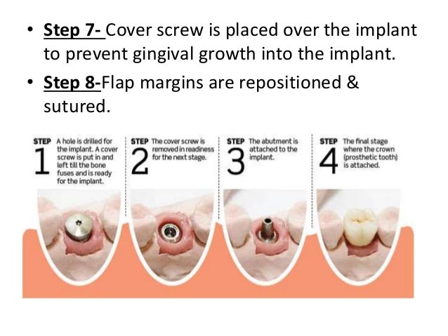 dental-implants-35-638.jpg?cb=1400144705