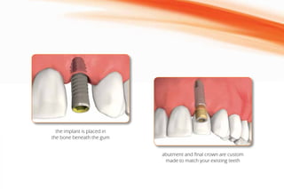 the implant is placed in
the bone beneath the gum
abutment and final crown are custom
made to match your existing teeth
 