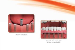 a custom-made denture is
secured to the implants
implants are placed
 