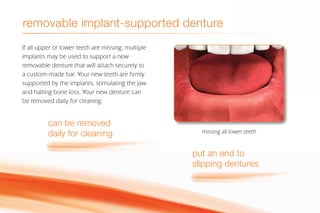 removable implant-supported denture
If all upper or lower teeth are missing, multiple
implants may be used to support a new
removable denture that will attach securely to
a custom-made bar. Your new teeth are firmly
supported by the implants, stimulating the jaw
and halting bone loss. Your new denture can
be removed daily for cleaning.
can be removed
daily for cleaning
put an end to
slipping dentures
missing all lower teeth
 