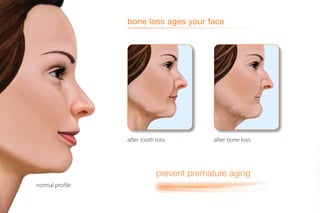 normal profile
after tooth loss after bone loss
bone loss ages your face
prevent premature aging
 