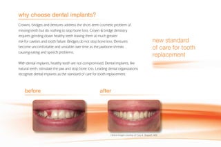 Crowns, bridges and dentures address the short-term cosmetic problem of
missing teeth but do nothing to stop bone loss. Crown & bridge dentistry
requires grinding down healthy teeth leaving them at much greater
risk for cavities and tooth failure. Bridges do not stop bone loss. Dentures
become uncomfortable and unstable over time as the jawbone shrinks
causing eating and speech problems.
With dental implants, healthy teeth are not compromised. Dental implants, like
natural teeth, stimulate the jaw and stop bone loss. Leading dental organizations
recognize dental implants as the standard of care for tooth replacement.
why choose dental implants?
afterbefore
Clinical images courtesy of Cary A. Shapoff, DDS
new standard
of care for tooth
replacement
 