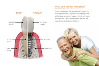what are dental implants?
tooth implant
gum
tissue
porcelain
crown
natural
tooth
implanttooth
root
jawbone
Dental implants are the new standard of care for
tooth replacement. They bond with healthy bone
and provide permanent support for dental crowns
and dentures. Dental implants look and feel like
natural teeth and can last a lifetime.
 