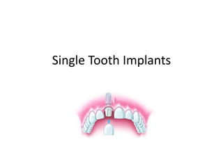 Single Tooth Implants
 
