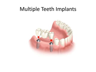 Multiple Teeth Implants
 
