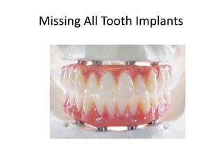 Missing All Tooth Implants
 