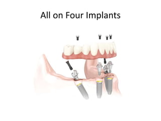 All on Four Implants
 