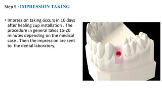 Dental implants | PPTX