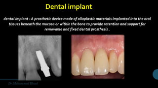 dental implant : A prosthetic device made of alloplastic materials implanted into the oral
tissues beneath the mucosa or within the bone to provide retention and support for
removable and fixed dental prosthesis .
Dental implant
 