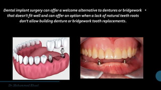 •Dental implant surgery can offer a welcome alternative to dentures or bridgework
that doesn't fit well and can offer an option when a lack of natural teeth roots
don't allow building denture or bridgework tooth replacements.
 